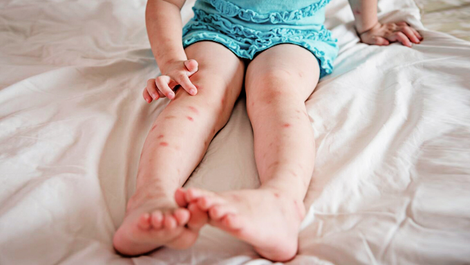 Is Your Child a Mosquito Magnet? 5 Reasons He's Getting Bitten More