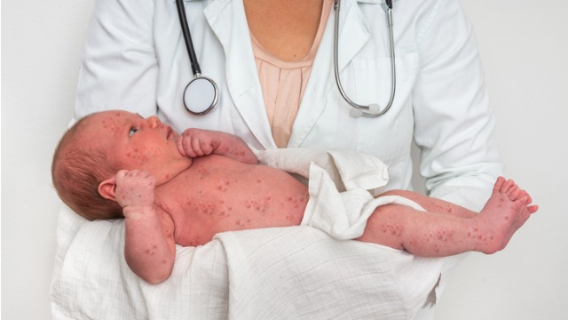 Bakit Mabilis Makahawa ang Tigdas o Measles? Narito ang Paliwanag ng Mga Doktor