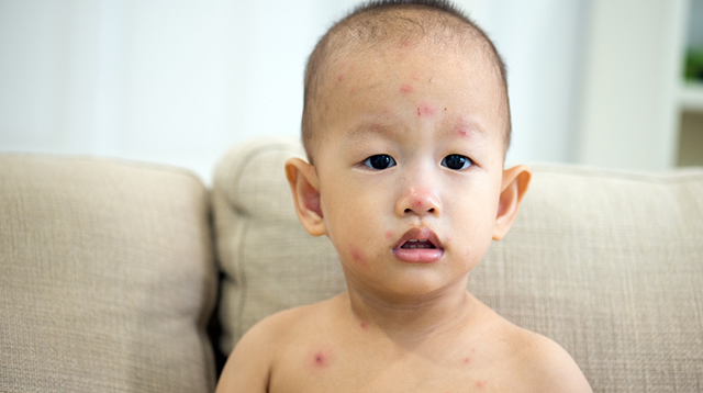 Chickenpox Parties Are a Bad Idea. Please Don't Attend or Host One