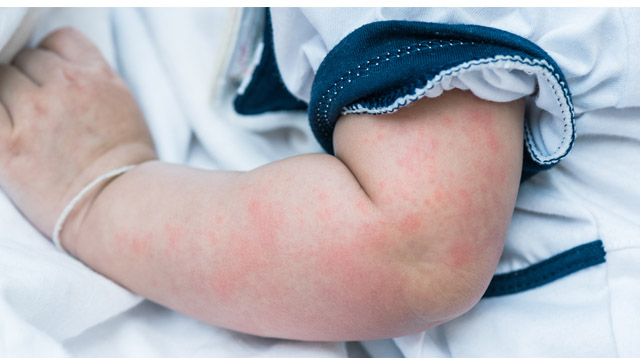 Urticaria in Children: What It Is, Why It Happens, and How to Treat It