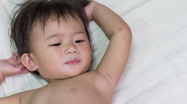 Here Are the Symptoms of Dengue You Need to Watch Out for in Your Baby
