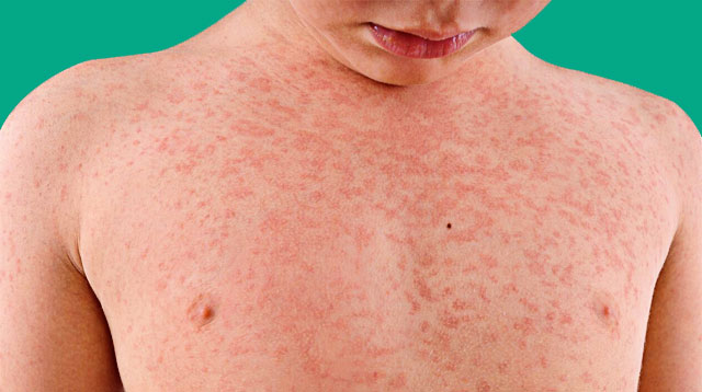 Measles May Cause 'Immune Amnesia' And Put Kids At Risk Of Catching Other Infections