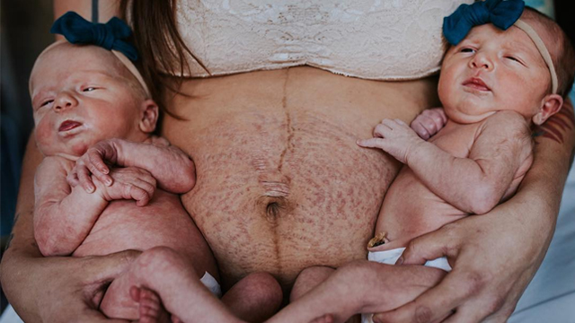 Mom Shares Powerful Message About Postpartum Stomach Following Birth of Twin Girls