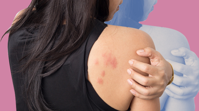 Rashes Could Be A Symptom Of COVID-19, According To Experts