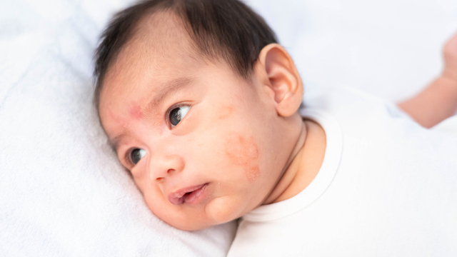 Skin Asthma, Atopic Dermatitis, Eczema: Are They All The Same?
