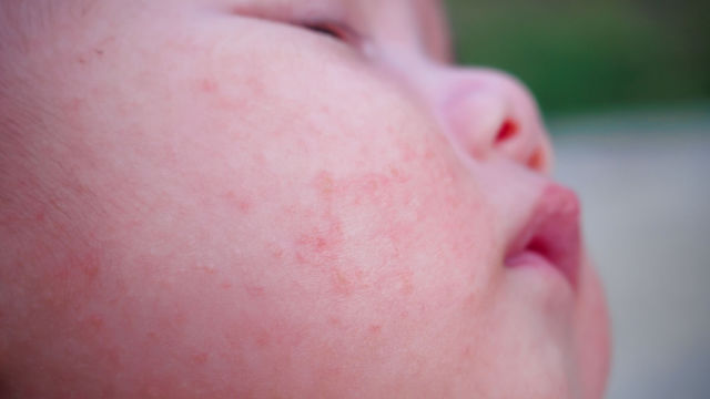Namumula, Nangangati, Namamantal Na Balat: Skin Asthma, Dermatitis, O Eczema Ba Ito?