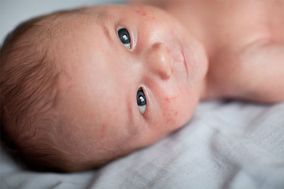 Red Spots On Newborn Baby Face Newborn Baby