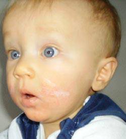 baby with skin asthma