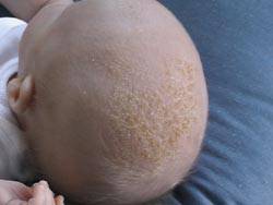 Should I Worry if My Child Has Cradle Cap?